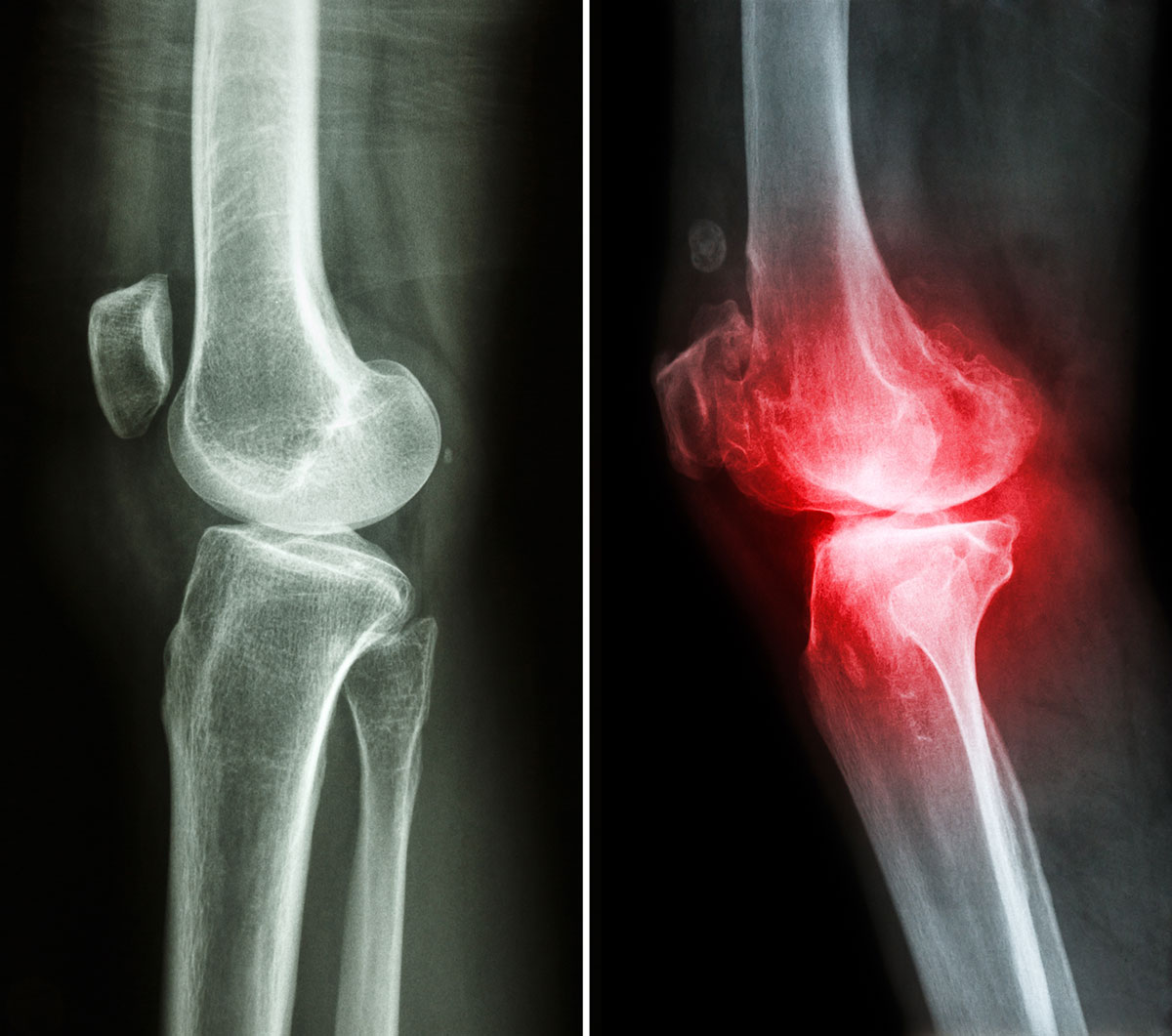 mit kell szedni osteoarthritis esetén erős fájdalom a térdízület hajlítása során